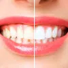 Colombia Marketplace Blanqueamiento Dental Martin Hiroshi Odontologo