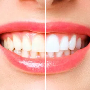 Colombia Marketplace Blanqueamiento Dental Martin Hiroshi Odontologo » Marketplace Colombia Colombia Marketplace Blanqueamiento Dental Martin Hiroshi Odontologo