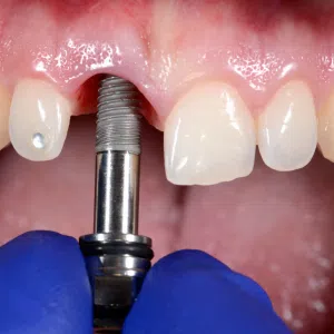 Implantología y Cirugía Oral