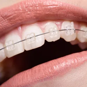 Ortodoncia con Brackets Estéticos