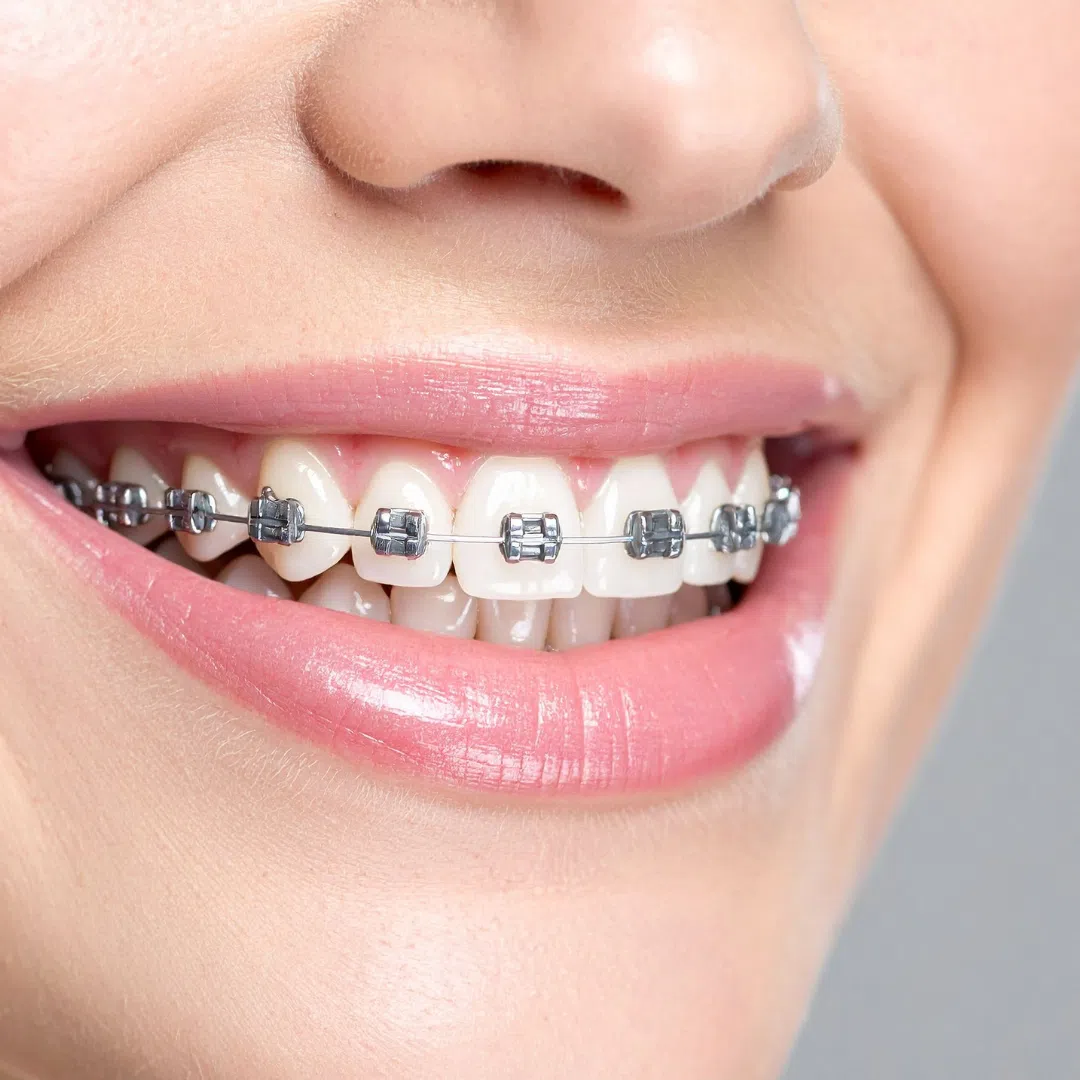 Ortodoncia Con Brackets Metálicos Martin Hiroshi 01 » Marketplace Colombia